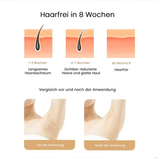 EverGlow IPL Haarentferner – Hautschonend, Schmerzfrei & Langanhaltend